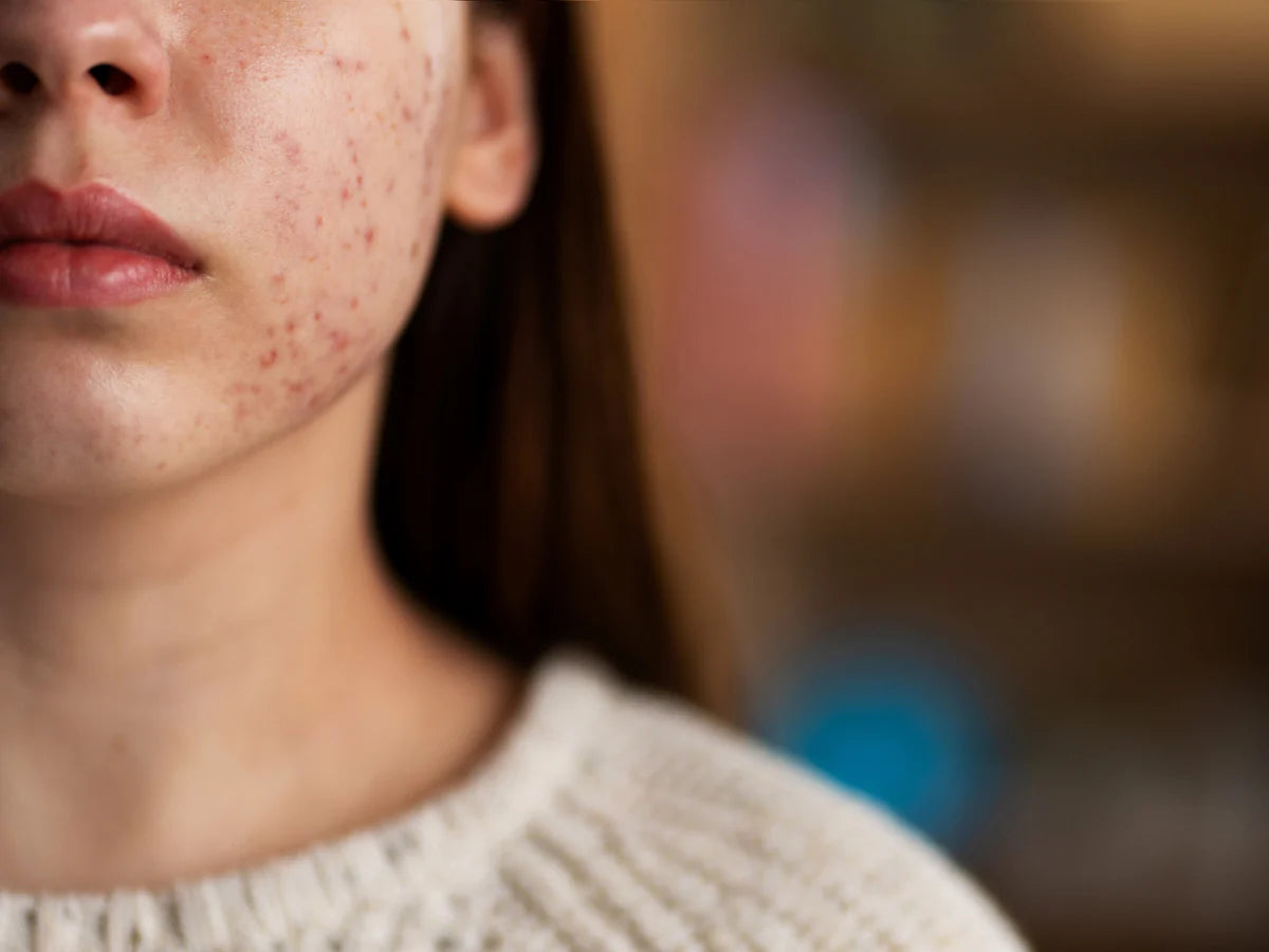 probiotique et acné